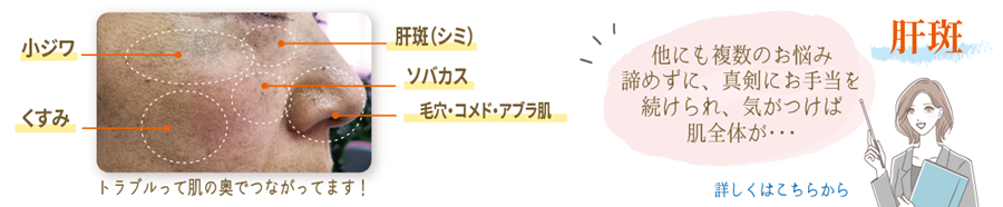 肝斑